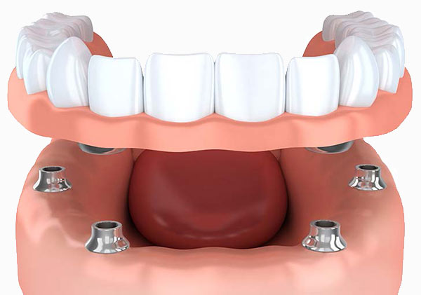 Implant retained Dentures