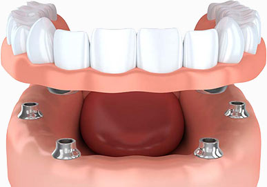 Implant retained denture