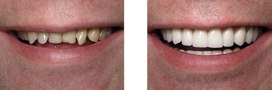 Veneers Before After