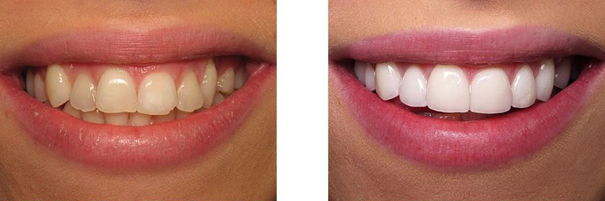 Veneers Before After 2