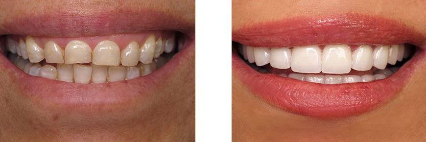 Veneers Before After 3