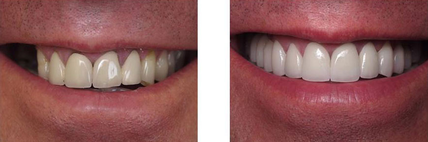 Veneers Before After 4