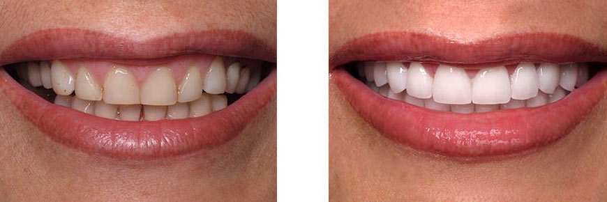 Veneers Before After 5