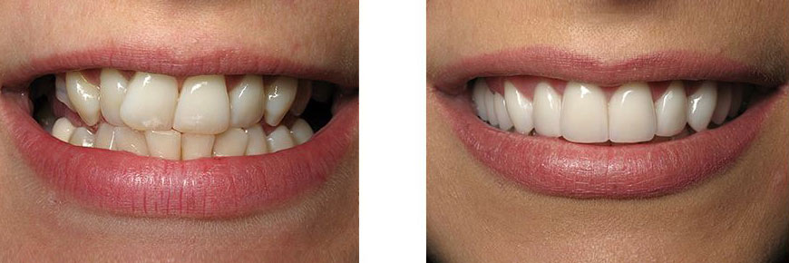 Veneers Before After 6