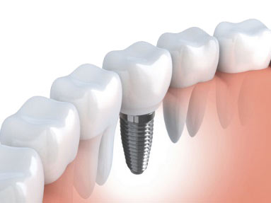 Dental Implants