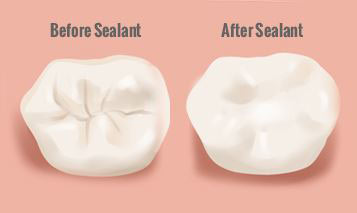 Before After Sealants