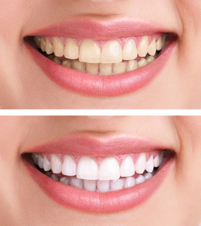 Before After Teeth Whitening