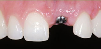 Dental Implant Figure 1