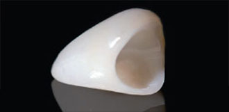 Dental Implant Figure 2