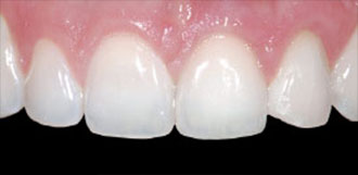 Dental Implant Figure 3