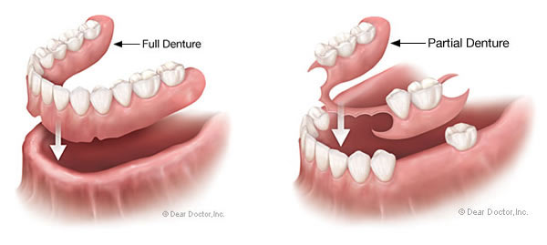 Partial Dentures