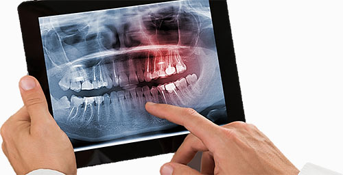 XRAY on iPad